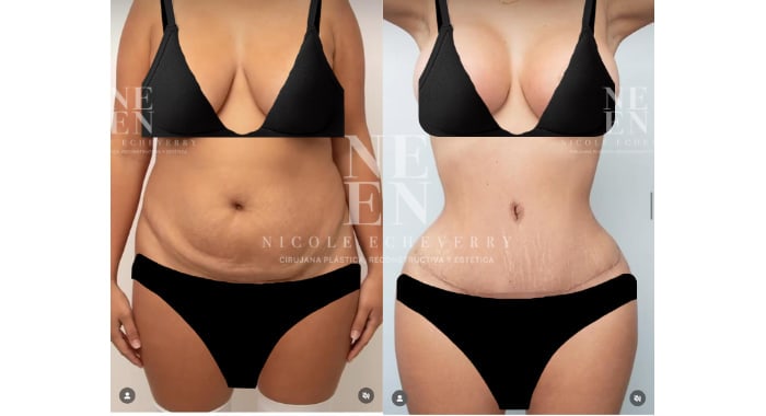 Before and after a Mommy Makeover