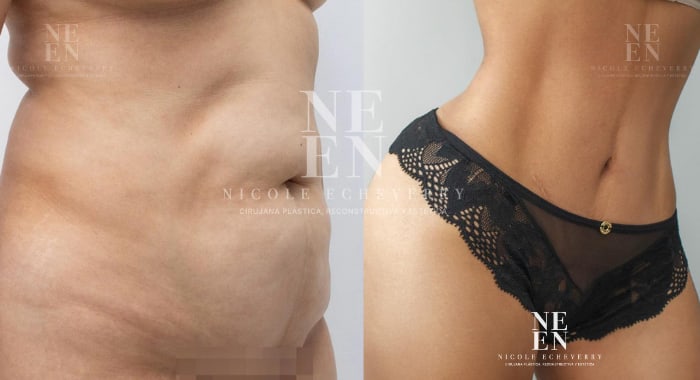 Before and after a Mommy Makeover