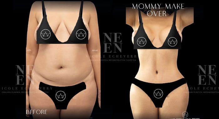 Before and after a Mommy Makeover