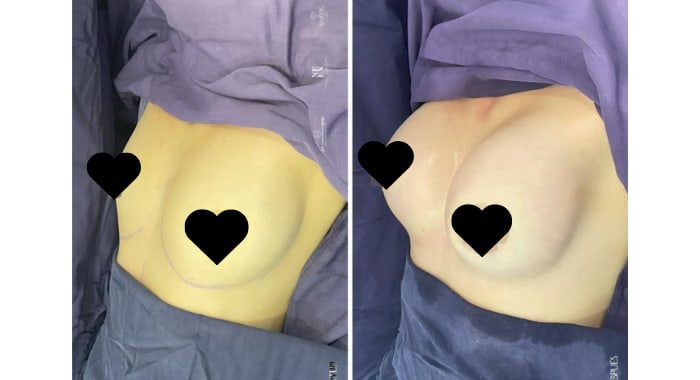 Before and after a Breast Lift & Augmentation, angled view