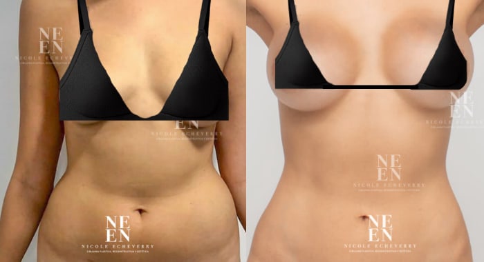 Before and after a Breast Lift & Augmentation, front view