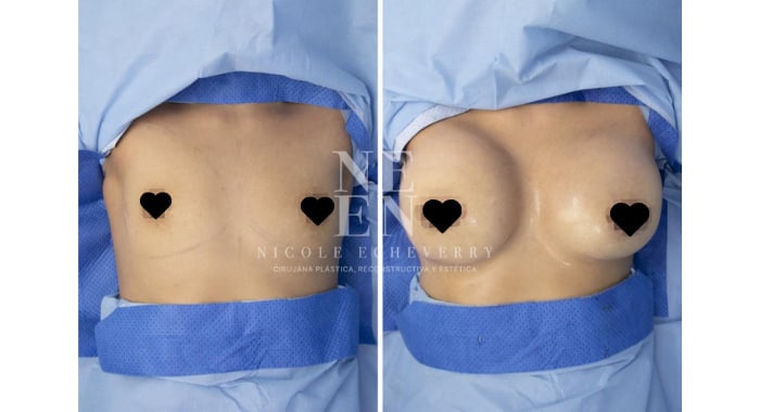 Before and after a Breast Lift & Augmentation, front view