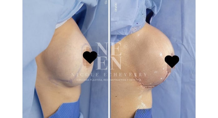 Before and after a Breast Lift & Augmentation, side view