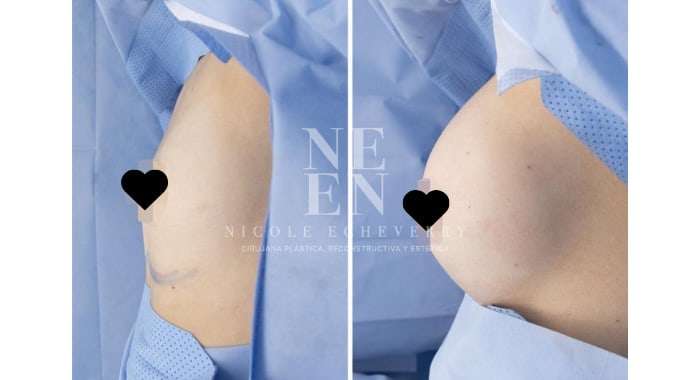 Before and after a Breast Lift & Augmentation, side view