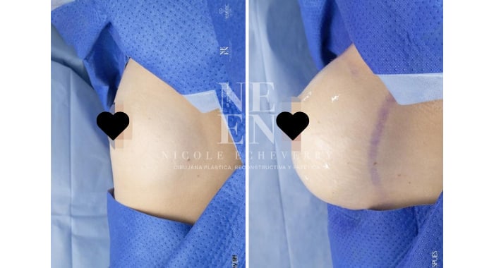 Before and after a Breast Lift & Augmentation, side view